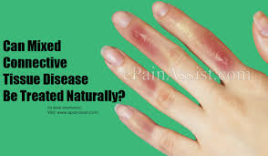 Can Mixed Connective Tissue Disease Be Treated Naturally