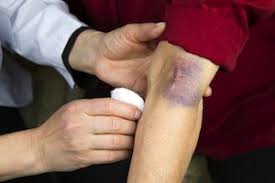 Image result for Wound