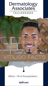 Vitiligo Facts