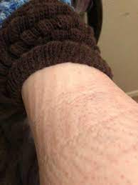 When Those Scary Sock Indentations Don T Mean Edema Scary Symptoms