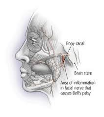 Bell's palsy is not usually a sign of something more serious. Bell S Palsy Guide Causes Symptoms And Treatment Options