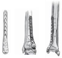 LCP Medial Distal Tibia Plate w/o tab 3.5