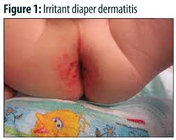 Image result for diaper dermatitis