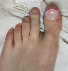 I am being checked with toenail melanoma next monday. Pedique Cosmetic Nail Replacment A A Podiatrists Chiropodists