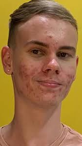 Uma humilhação básica #foryou#acne#roacutan