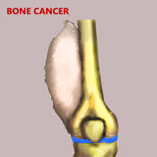 Likewise called gastric cancer, the disease usually grows slowly over several years. Best Cancer Hospital In India Bone Cancer Treatment In Coimbatore Tamil Nadu