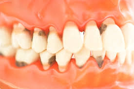 Clinica Dental En Gijon Causas Y Sintomas De La Periodontitis