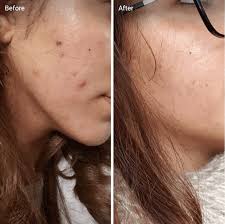 Vitamin c supplement skin before after. Vitamin C For Acne Scars Efficacy How It Works Before And Afters