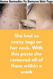 She Had So Many Tags On Her Neck With This Paste She Removed All Of Them Within A Week Today I Am Sharin Skin Tag Removal Skin Tags On Face Skin