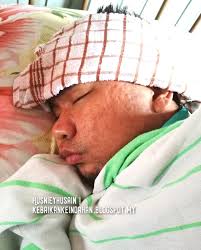 Rasa gatal di sekitar miss v (vagina) dan keluarnya cairan atau kotoran dari saat ini sudah banyak tersedia obat gonore atau obat kencing nanah terbuat dari bahan alami atau lebih dikenal dengan obat herbal alami untuk. Suami Demam Chicken Pox Petanda Dan Petua Nak Sembuh Husniey Husain
