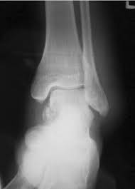 Image result for Ankle XRay