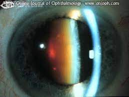 It was felt that the clouding of vision was do to a film falling like water. Atlas Of Ophthalmology