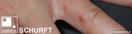 Schurft wordt veroorzaakt door de schurftmijt. Schurft Actuele Informatie Huidinfo Nl Dermatoloog