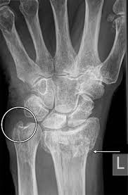 To download this image, create an account. Imaging Findings Of Metabolic Bone Disease Radiographics