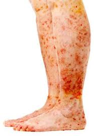 Image result for Sarcoma