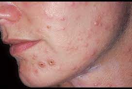 But i do not quite understand the algorithm how to do it. Varicella Zoster Virus Infection Face Picture Image On Medicinenet Com