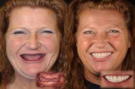 Maybe you would like to learn more about one of these? Same Day New Smile Dental Implants By Dr Shawn Keller Kirkland Wa