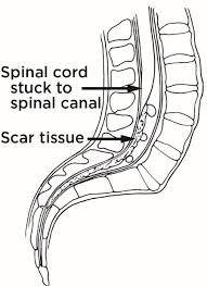 Image result for Syringomyelia