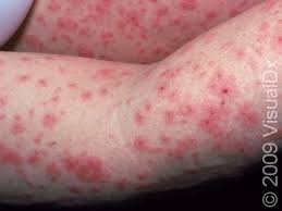 Image result for pruritic urticarial papules and plaques of pregnancy