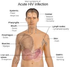 Hiv, or human immunodeficiency virus, is a type of virus that infects human immune cells. What Are The Signs Symptoms Of Hiv Aids In Men And Women Easystd