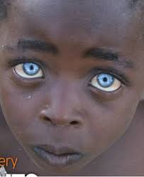 Black And Blue Eyes After Head Injury Acting White Acting Black Blue Eyes Blacks And Occular Albinism Black Girl Blue Eyes Blue Eyes Black With Blue Eyes