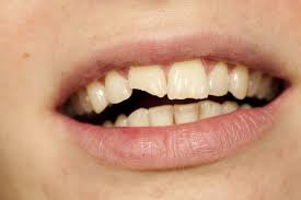Having Chipped And Damaged Teeth Repaired Broken Tooth Repair Tooth Repair Broken Tooth