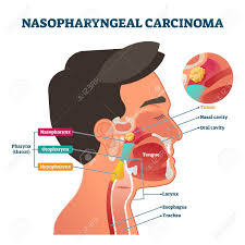 This material has been provided by ucl library services. Nasopharyngeal Carcinoma Tumor Vector Illustration Labeled Diagram Royalty Free Cliparts Vectors And Stock Illustration Image 141801184