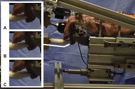 Image result for Elson Extensor Tendon Test