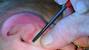 Bump In Ear Canal