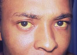 Skin cancer is the most common type of cancer in the united states by a pretty large margin, and it does not discriminate. Jaundice Description Symptoms Causes Treatment Britannica