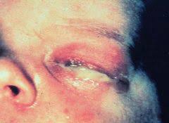 Image result for Gonococcal Conjunctivitis