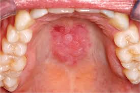 Image result for Mouth ulcers symptoms roof of the mouth