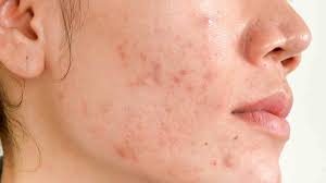 Acne Hormonal Cuales Son Las Causas Y Como Tratarlo