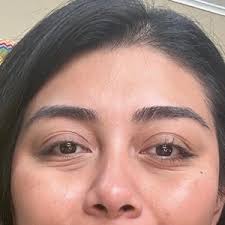 Which procedure would minimize the appearance of my deep under eye bags and  wrinkles? (photos)