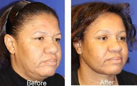 He and partner, board certified general plastic surgeon dr. Eyebrow Lift Long Island And New York City Dr Amiya Prasad