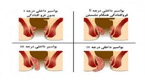 بواسیر داخلی و خارجی چیست اخبار رسمی