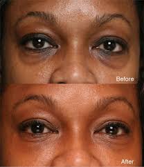 There are ways to combat dark eyelids helping you to restore your youthful beauty once again. Dark Circles Casy Study Examples Before After Lidlift