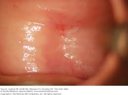 Image result for Atrophic Vaginitis