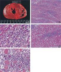Symptoms can include shortness of breath, chest pain, decreased ability to exercise, and an irregular heartbeat. Giant Cell Myocarditis And Polymyositis A Macroscopic Findings Of The Download Scientific Diagram