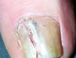 See before and after photos of patients who have undergone reconstructive plastic surgery after skin cancer removal (mohs surgery). Melanoma Of Nail Unit Images Dermnet Nz