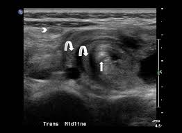 Image result for Midgut Volvulus