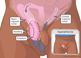 Image result for Inguinal hernia child