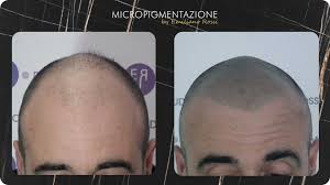Effetto ricostruttivo o di infoltimento pre/post autotrapianto di capelli . Il Cambiamento Di Giovanni Micropigmentazione Tricologica Udine Emiliano Rossi