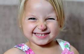 Op ends 'clown nose' birthmark misery of girl, 3