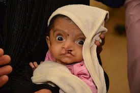 Requirements, prospective adoptive parents need to meet mexican requirements to adopt a child from mexico: Should You Adopt A Child With Cleft Lip Palate