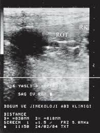 Follicle Development On The Right Ovarian Remnant Tissue Rot Download Scientific Diagram