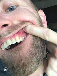 Abnormality What Is This It S A Bump On My Gum And Is Inflamed But Not Causing Me Any Pain In Boot Camp They Shaved My Tooth Down Because They Said There Was