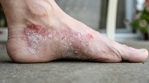 Image result for psoriasis