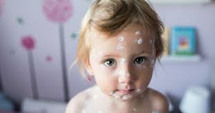 Chickenpox usually clears up within a couple of weeks. Perbedaan Cacar Air Dan Cacar Api Lebih Bahaya Mana Popmama Com