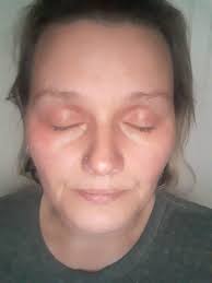 Just found out about a side effect of the keto diet....keto rash. Some  people develop a rash